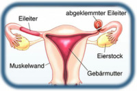 Sterilisation mit Clip-Methode