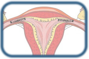 Essure Sterilisation (Uterusspiegelung)